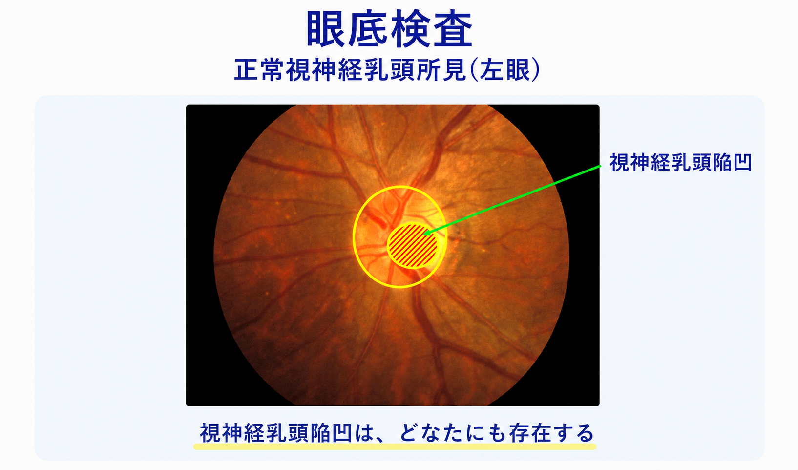眼底検査：正常視神経乳頭の所見