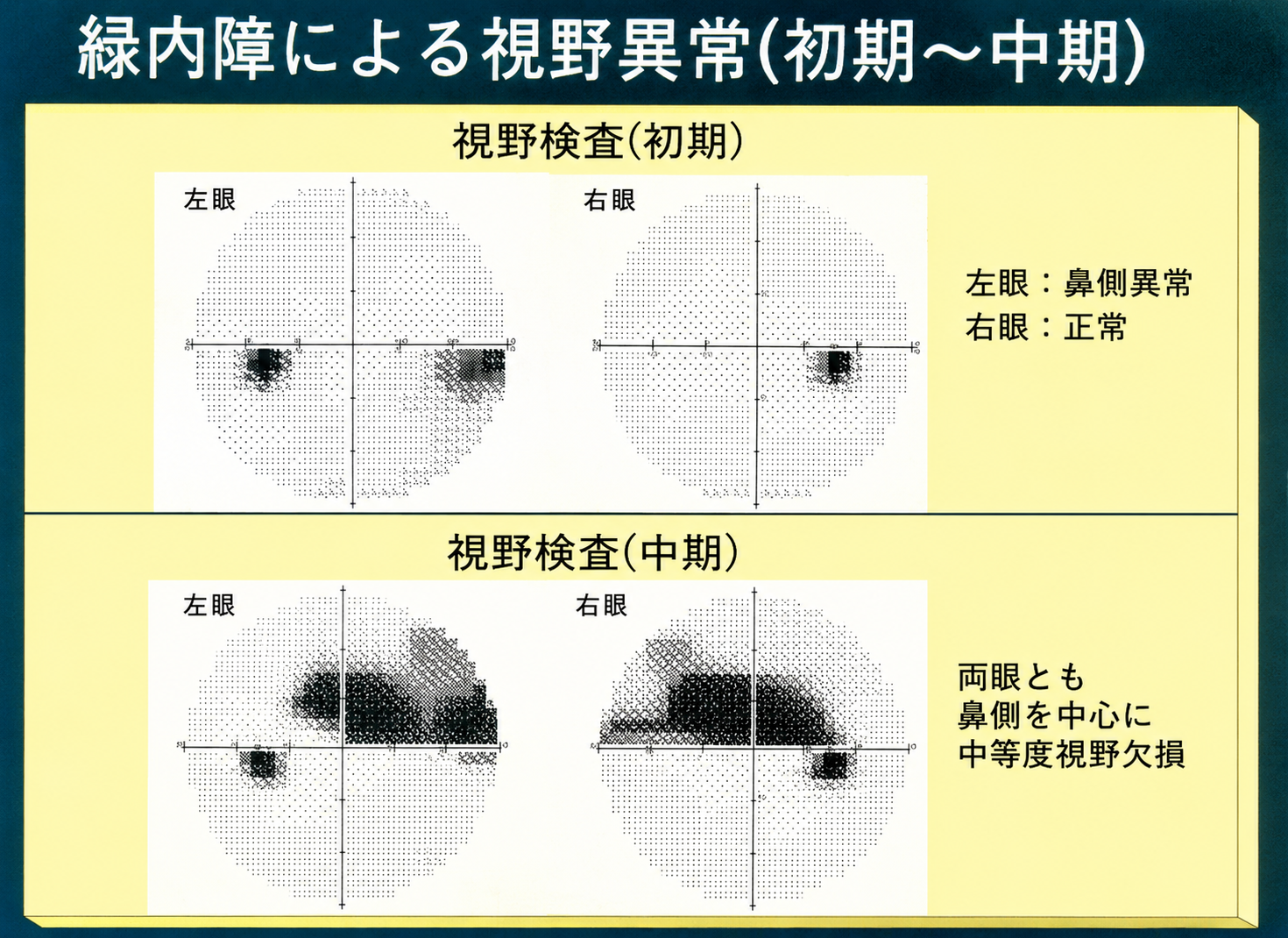 緑内障による視野異常（初期〜中期）