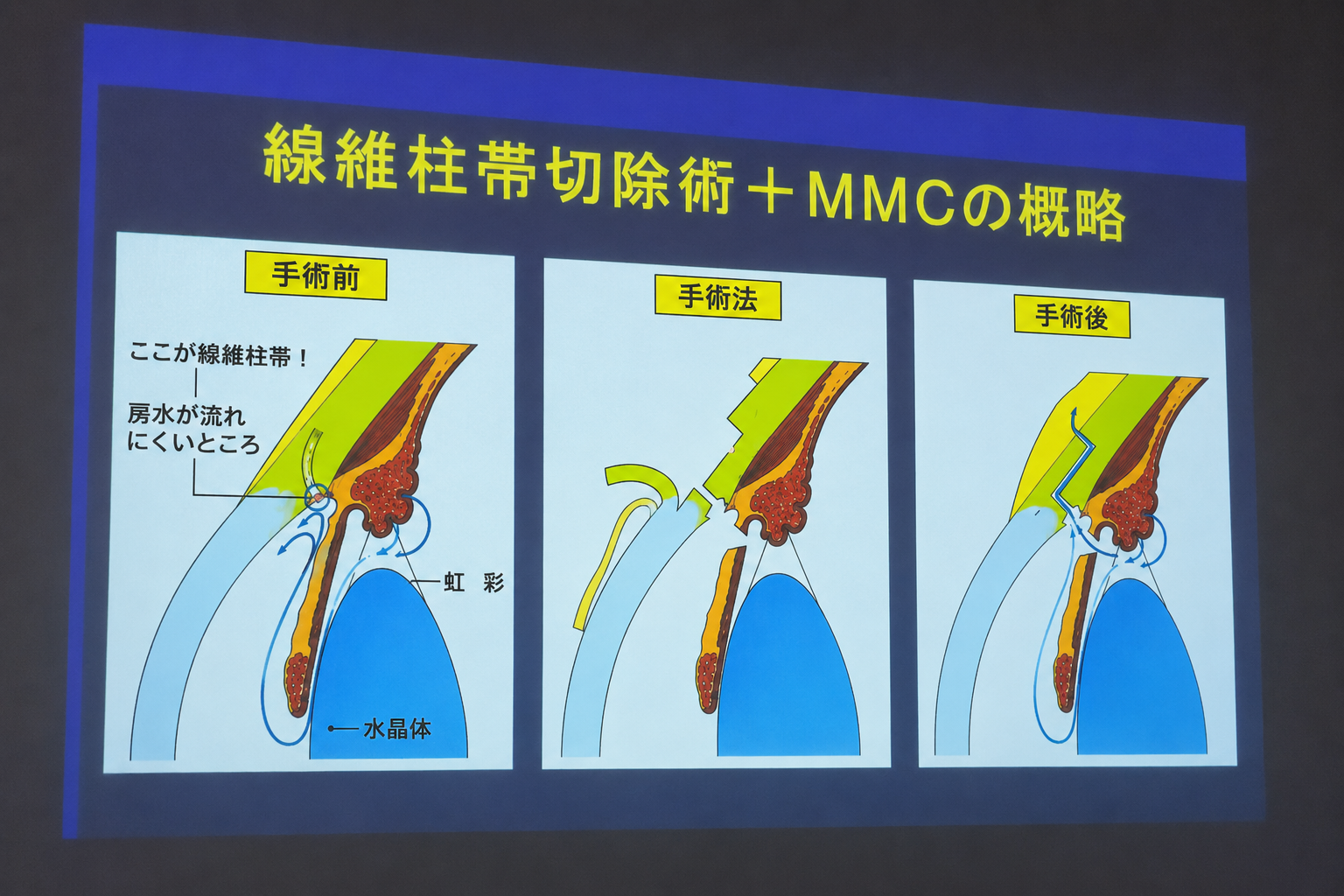 緑内障勉強会の様子