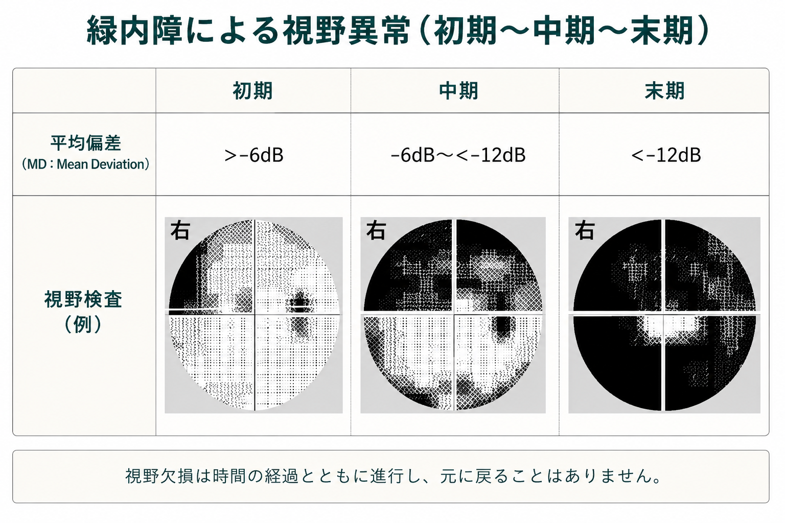 ハンフリー視野検査による緑内障の視野変化（初期から末期）