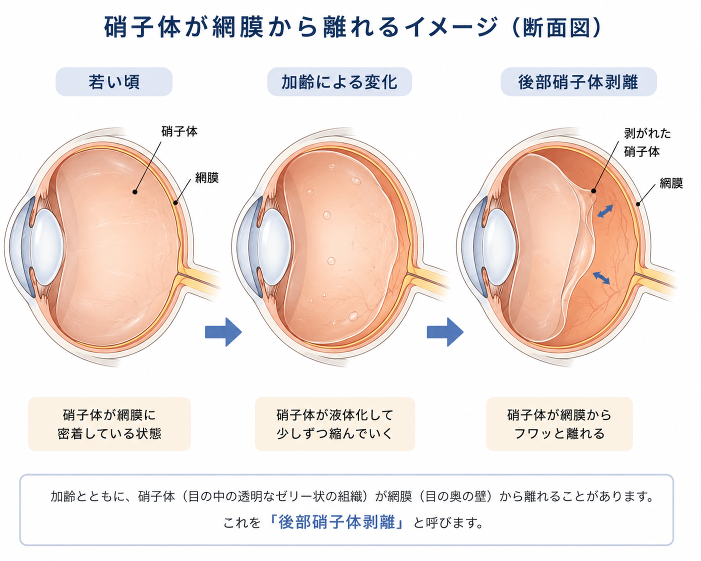 後部硝子体剥離のイラスト（硝子体が網膜から離れる様子）